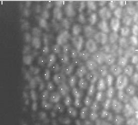 Figure 7 ophthalmic cases, keratoplasty, laser assisted keratoplasty, femtosecond laser, Fuchs endothelial dystrophy, top hat